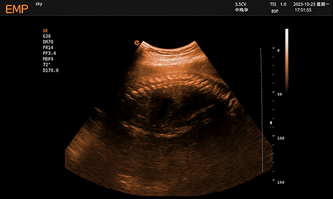 Fetal Spine