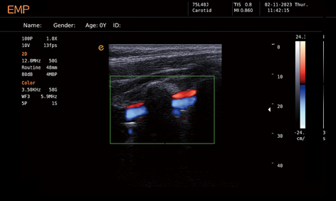 Carotid Artery