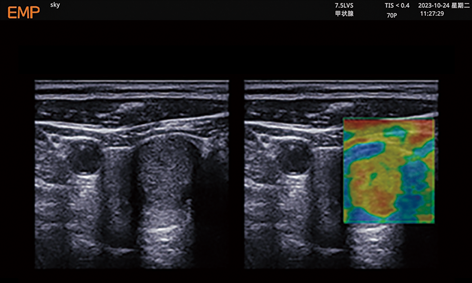 Thyroid